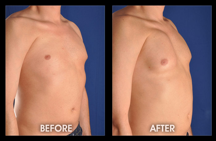 Pectoral Implants - Pecs, Male Chest Reconstruction, Male Plastic Surgery