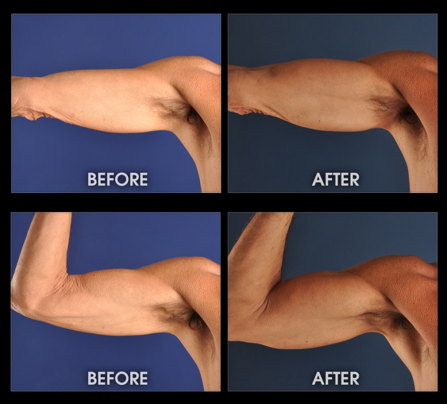 Triceps Implants - Before and After Photos, Muscle Augmentation