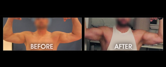 Bicep Implants - Augmentation