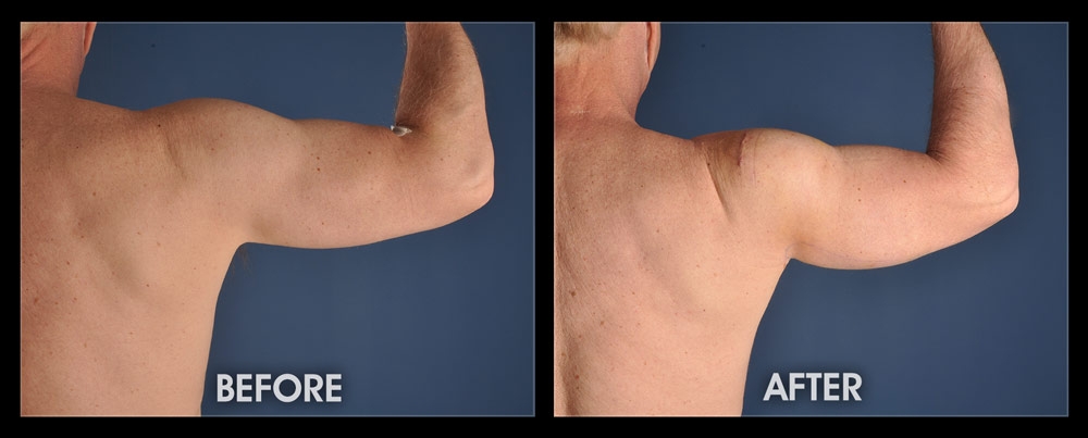 Triceps Implants - Before and After Photos, Muscle Augmentation