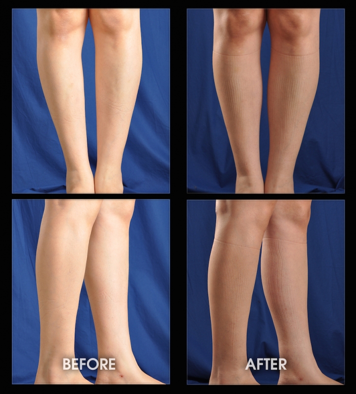 Estetica Europe  Curved Lower Legs and Calf Implants - ro