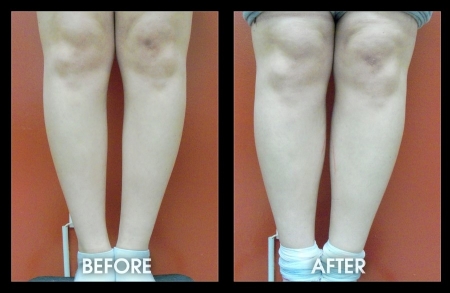 Calf Implants - Body Implants, Plastic Surgery, Augmentation