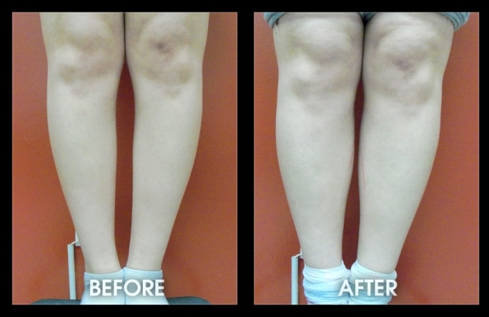 Before and After - Calf-Implants