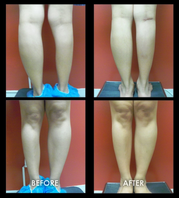 Calf Implants Before and After Photos Leg Muscle Augmentation