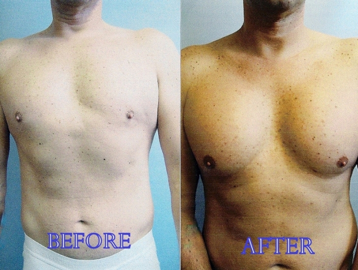 before-after-pectoral-implants-03