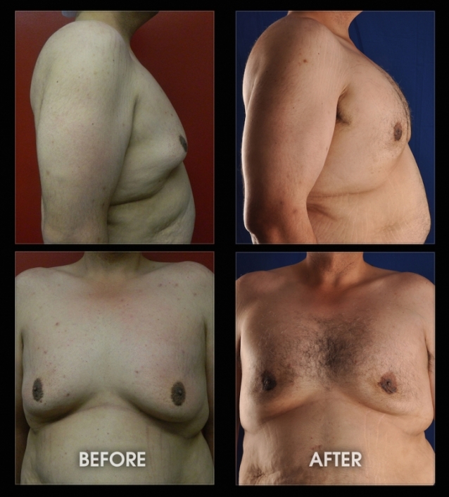 before-after-pectoral-implants-06