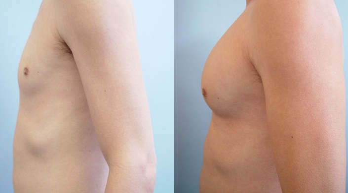 before-after-pectoral-implants-17