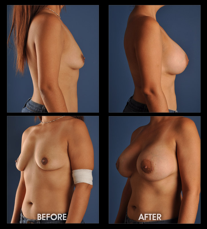 Breast Implants - Before and After Image Gallery, Plastic Surgery