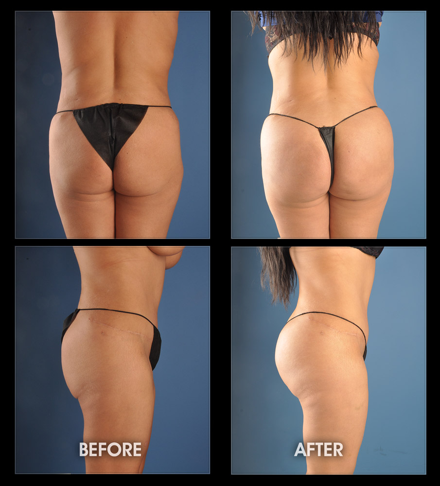 Buttock Implants - Before and After Image Gallery, Plastic Surgery