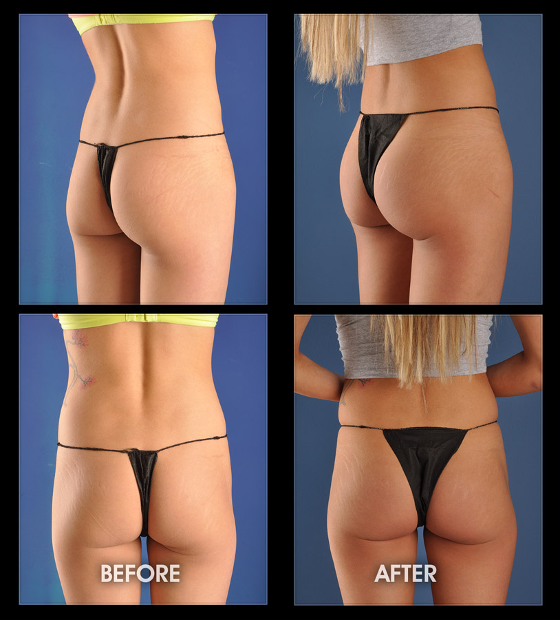 What you need to know about butt augmentation - Plastic Surgery