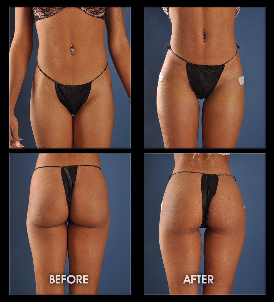 Hip Implants - Thigh Implants, Surgery, Hip Dips, Hourglass Figure