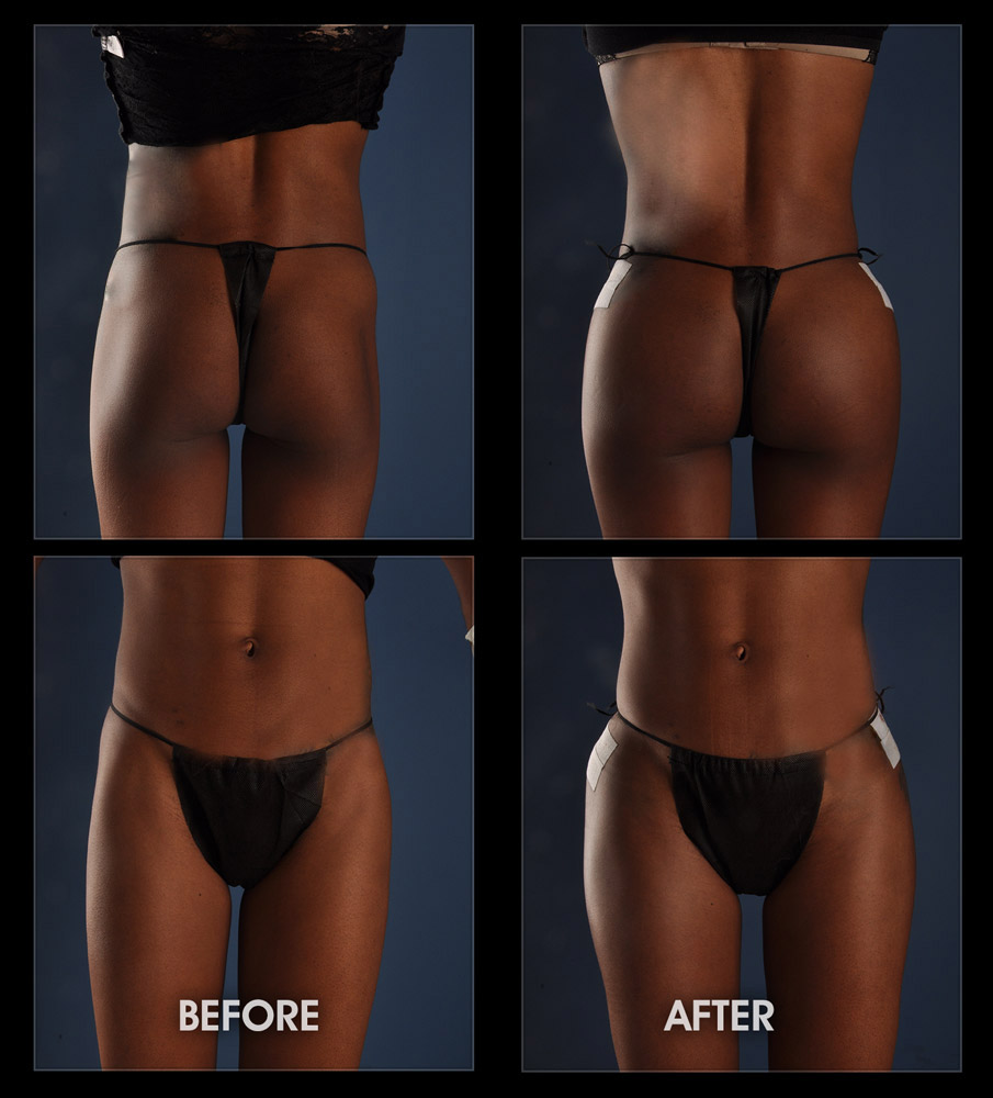 Hip Implants - Thigh Implants, Surgery, Hip Dips, Hourglass Figure