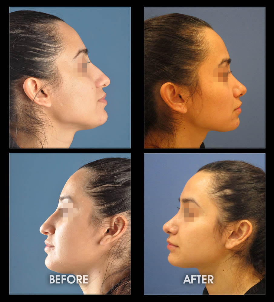Rhinoplasty Los Angeles - Closed, No External Scars, California